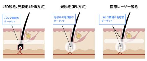 チンコ脱毛|男性器の医療脱毛とは？